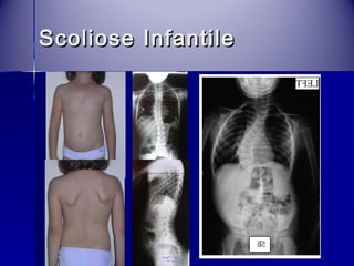 SSccoolliioossee IInnffaannttiillee 
 