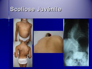 SSccoolliioossee JJuuvvéénniillee 
 