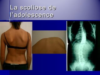 LLaa ssccoolliioossee ddee 
ll’’aaddoolleesscceennccee 
 