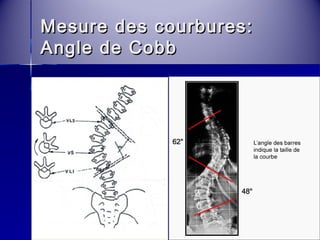 Mesure ddeess ccoouurrbbuurreess:: 
AAnnggllee ddee CCoobbbb 
 