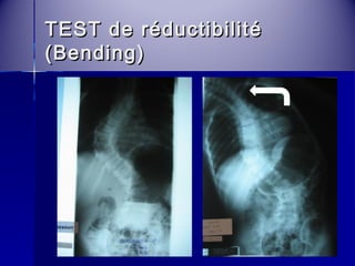 TEST ddee rréédduuccttiibbiilliittéé 
((BBeennddiinngg)) 
 