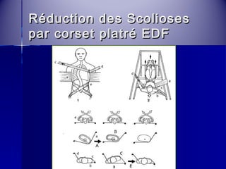 Réduction ddeess SSccoolliioosseess 
ppaarr ccoorrsseett ppllaattrréé EEDDFF 
 