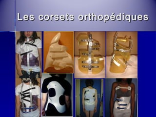 Les corsets oorrtthhooppééddiiqquueess 
 