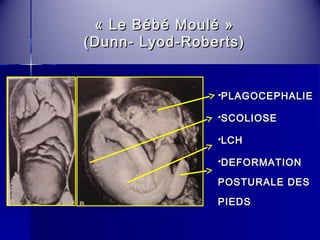 « LLee BBéébbéé MMoouulléé » 
((DDuunnnn-- LLyyoodd--RRoobbeerrttss)) 
PPLLAAGGOOCCEEPPHHAALLIIEE 
SSCCOOLLIIOOSSEE 
LLCCHH 
DDEEFFOORRMMAATTIIOONN 
PPOOSSTTUURRAALLEE DDEESS 
PPIIEEDDSS 
 