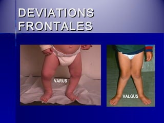 DDEEVVIIAATTIIOONNSS 
FFRROONNTTAALLEESS 
VARUS 
VALGUS 
 