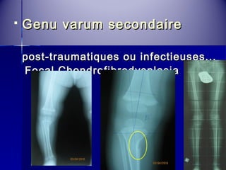  Genu vvaarruumm sseeccoonnddaaiirree 
ppoosstt--ttrraauummaattiiqquueess oouu iinnffeeccttiieeuusseess...... 
FFooccaall CChhoonnddrrooffiibbrrooddyyssppllaassiiaa 
 