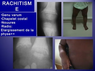 RACHITISM 
E 
•Genu varum 
•Chapelet costal 
•Nouures 
•Radio: 
Elargissement de la 
physe++ 
 