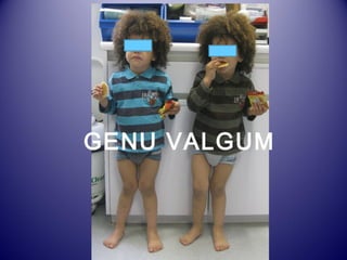 GENU VALGUM 
 