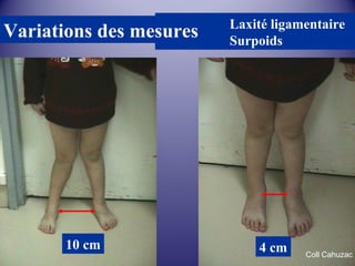Laxité ligamentaire 
Surpoids Variations des mesures 
10 cm 4 cm Coll Cahuzac 
 