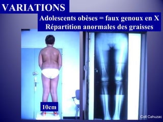 VARIATIONS 
Adolescents obèses = faux genoux en X 
Répartition anormales des graisses 
10cm 
Coll Cahuzac 
 