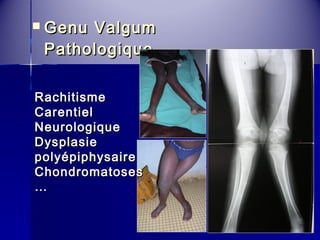  GGeennuu VVaallgguumm 
PPaatthhoollooggiiqquuee 
RRaacchhiittiissmmee 
CCaarreennttiieell 
NNeeuurroollooggiiqquuee 
DDyyssppllaassiiee 
ppoollyyééppiipphhyyssaaiirree 
CChhoonnddrroommaattoosseess 
…… 
 