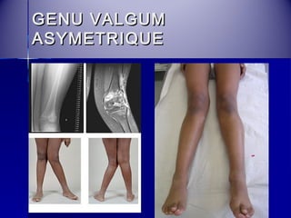 GGEENNUU VVAALLGGUUMM 
AASSYYMMEETTRRIIQQUUEE 
 