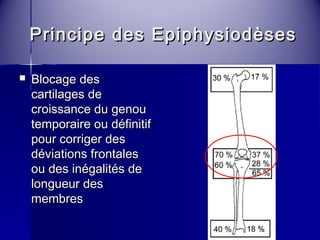 Principe ddeess EEppiipphhyyssiiooddèèsseess 
 BBllooccaaggee ddeess 
ccaarrttiillaaggeess ddee 
ccrrooiissssaannccee dduu ggeennoouu 
tteemmppoorraaiirree oouu ddééffiinniittiiff 
ppoouurr ccoorrrriiggeerr ddeess 
ddéévviiaattiioonnss ffrroonnttaalleess 
oouu ddeess iinnééggaalliittééss ddee 
lloonngguueeuurr ddeess 
mmeemmbbrreess 
 