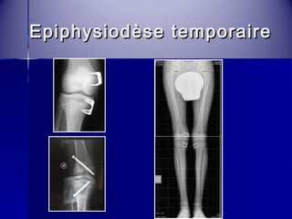 Epiphysiodèse tteemmppoorraaiirree 
 