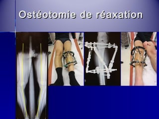 Ostéotomie ddee rrééaaxxaattiioonn 
 
