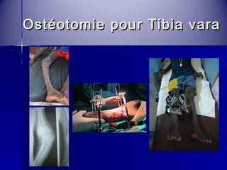 Ostéotomie ppoouurr TTiibbiiaa vvaarraa 
 