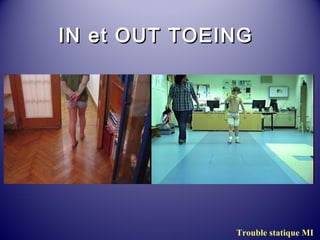 IINN eett OOUUTT TTOOEEIINNGG 
Trouble statique MI 
 