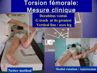 TToorrssiioonn fféémmoorraallee:: 
MMeessuurree cclliinniiqquuee 
Decubitus vental. 
G troch at its greatest 
Vertical line / axes leg 
Netter method Medial rotation / Antetorsion 
 