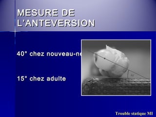 MMEESSUURREE DDEE 
LL’’AANNTTEEVVEERRSSIIOONN 
4400°° cchheezz nnoouuvveeaauu--nnéé 
1155°° cchheezz aadduullttee 
Trouble statique MI 
 