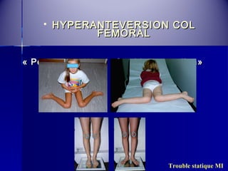  HYPERANTEVERSION CCOOLL 
FFEEMMOORRAALL 
« PPoossiittiioonn eenn WW» ++ «SSttrraabbiissmmee rroottuulliieenn» 
Trouble statique MI 
 