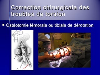 Correction cchhiirruurrggiiccaallee ddeess 
ttrroouubblleess ddee ttoorrssiioonn 
 OOssttééoottoommiiee fféémmoorraallee oouu ttiibbiiaallee ddee ddéérroottaattiioonn 
 