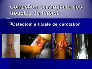 CCoorrrreeccttiioonn cchhiirruurrggiiccaallee ddeess 
ttrroouubblleess ddee ttoorrssiioonn 
Ostéotomie tibiale ddee ddéérroottaattiioonn 
 