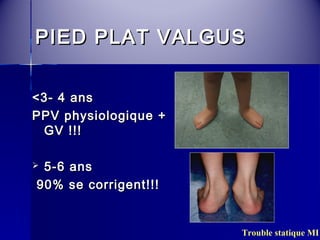 PPIIEEDD PPLLAATT VVAALLGGUUSS 
Trouble statique MI 
<<33-- 44 aannss 
PPPPVV pphhyyssiioollooggiiqquuee ++ 
GGVV !!!!!! 
 55--66 aannss 
9900%% ssee ccoorrrriiggeenntt!!!!!! 
 