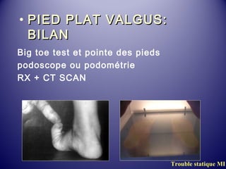 • PPIIEEDD PPLLAATT VVAALLGGUUSS:: 
BBIILLAANN 
Big toe test et pointe des pieds 
podoscope ou podométrie 
RX + CT SCAN 
Trouble statique MI 
 