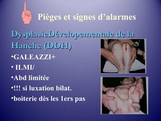 Pièges et signes d’alarmes 
DysplasieDévelopementale ddee llaa 
HHaanncchhee ((DDDDHH)) 
•GALEAZZI+ 
• ILMI/ 
•Abd limitée 
•!!! si luxation bilat. 
•boiterie dès les 1ers pas 
 