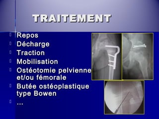 TTRRAAIITTEEMMEENNTT 
 RReeppooss 
 DDéécchhaarrggee 
 TTrraaccttiioonn 
 MMoobbiilliissaattiioonn 
 OOssttééoottoommiiee ppeellvviieennnnee 
eett//oouu fféémmoorraallee 
 BBuuttééee oossttééooppllaassttiiqquuee 
ttyyppee BBoowweenn 
 …… 
 