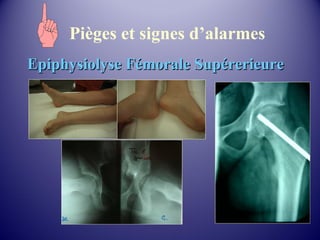 Pièges et signes d’alarmes 
EEppiipphhyyssiioollyyssee FFéémmoorraallee SSuuppéérreerriieeuurree 
 