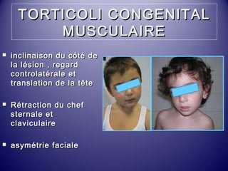 TORTICOLI CCOONNGGEENNIITTAALL 
MMUUSSCCUULLAAIIRREE 
 iinncclliinnaaiissoonn dduu ccôôttéé ddee 
llaa llééssiioonn ,, rreeggaarrdd 
ccoonnttrroollaattéérraallee eett 
ttrraannssllaattiioonn ddee llaa ttêêttee 
 RRééttrraaccttiioonn dduu cchheeff 
sstteerrnnaallee eett 
ccllaavviiccuullaaiirree 
 aassyymmééttrriiee ffaacciiaallee 
 