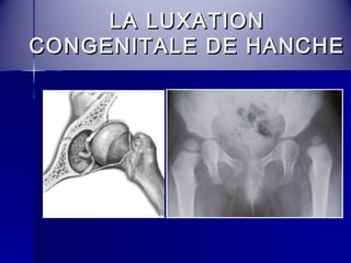 LLAA LLUUXXAATTIIOONN 
CCOONNGGEENNIITTAALLEE DDEE HHAANNCCHHEE 
 