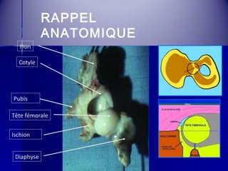RAPPEL 
ANATOMIQUE 
Ilion 
Cotyle 
Pubis 
Tête fémorale 
Ischion 
Diaphyse 
 