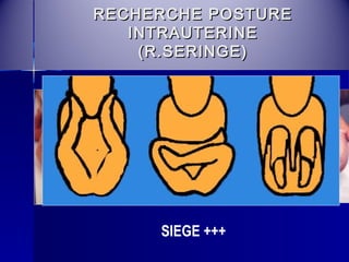RREECCHHEERRCCHHEE PPOOSSTTUURREE 
IINNTTRRAAUUTTEERRIINNEE 
((RR..SSEERRIINNGGEE)) 
SIEGE +++ 
 