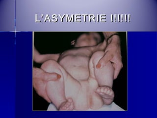 LL’’AASSYYMMEETTRRIIEE !!!!!!!!!!!! 
 