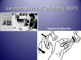La manoeuvre dd’’OOrrttoollaannii((11993377)) 
RESSAUT DE REDUCTION 
 