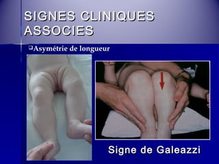 SSIIGGNNEESS CCLLIINNIIQQUUEESS 
AASSSSOOCCIIEESS 
Asymétrie de longueur 
SSiiggnnee ddee GGaalleeaazzzzii 
 