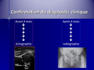 Confirmation dduu ddiiaaggnnoossttiicc cclliinniiqquuee 
Avant 4 mois 
 
 
 
 
échographie 
Après 4 mois 
 
 
 
 
radiographie 
 