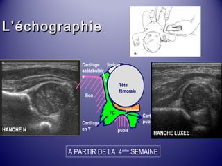 LL’’éécchhooggrraapphhiiee 
Cartilage limbus 
acétabulair 
e 
Cartilage 
en Y 
Tête 
fémorale 
Ilion 
HANCHE N pubis 
HANCHE LUXEE 
Cartilage 
pubien 
pulvina 
FC r 
A PARTIR DE LA 4ème SEMAINE 
 