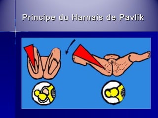 Principe du HHaarrnnaaiiss ddee PPaavvlliikk 
 