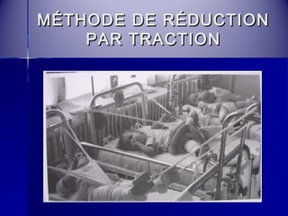 MÉTHODE DDEE RRÉÉDDUUCCTTIIOONN 
PPAARR TTRRAACCTTIIOONN 
 