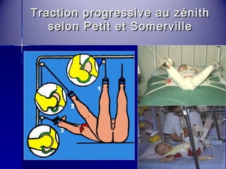 Traction progressive aauu zzéénniitthh 
sseelloonn PPeettiitt eett SSoommeerrvviillllee 
 
