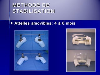 MMEETTHHOODDEE DDEE 
SSTTAABBIILLIISSAATTIIOONN 
► AAtttteelllleess aammoovviibblleess: 44 àà 66 mmooiiss 
 