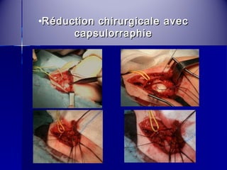 •Réduction cchhiirruurrggiiccaallee aavveecc 
ccaappssuulloorrrraapphhiiee 
 