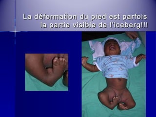 La déformation du pied eesstt ppaarrffooiiss 
llaa ppaarrttiiee vviissiibbllee ddee ll’’iicceebbeerrgg!!!!!! 
 