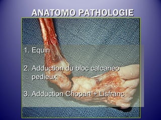 AANNAATTOOMMOO PPAATTHHOOLLOOGGIIEE 
11.. EEqquuiinn 
22.. AAdddduuccttiioonn dduu bblloocc ccaallccaanneeoo 
ppeeddiieeuuxx 
33.. AAdddduuccttiioonn CChhooppaarrtt ++ LLiissffrraanncc 
 