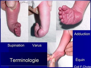 SSuuppiinnaattiioonn VVaarruuss 
AAdddduuccttiioonn 
TTTTeeeerrrrmmmmiiiinnnnoooollllooooggggiiiieeee ÉÉqquuiinn 
Coll F.Chotel 
 