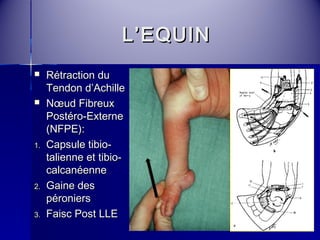 LL’’EEQQUUIINN 
 RRééttrraaccttiioonn dduu 
TTeennddoonn dd’’AAcchhiillllee 
 NNoeoeuudd FFiibbrreeuuxx 
PPoossttéérroo--EExxtteerrnnee 
((NNFFPPEE)):: 
11.. CCaappssuullee ttiibbiioo-- 
ttaalliieennnnee eett ttiibbiioo-- 
ccaallccaannééeennnnee 
22.. GGaaiinnee ddeess 
ppéérroonniieerrss 
33.. FFaaiisscc PPoosstt LLLLEE 
 