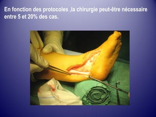 En fonction des protocoles ,la chirurgie peut-être nécessaire 
entre 5 et 20% des cas. 
 